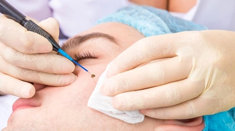 Các phương pháp tẩy nốt ruồi cần thực hiện đúng kỹ thuật