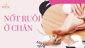 not-ruoi-o-got-chan-noi-len-dieu-gi-giai-ma-van-menh-nam-va-_354