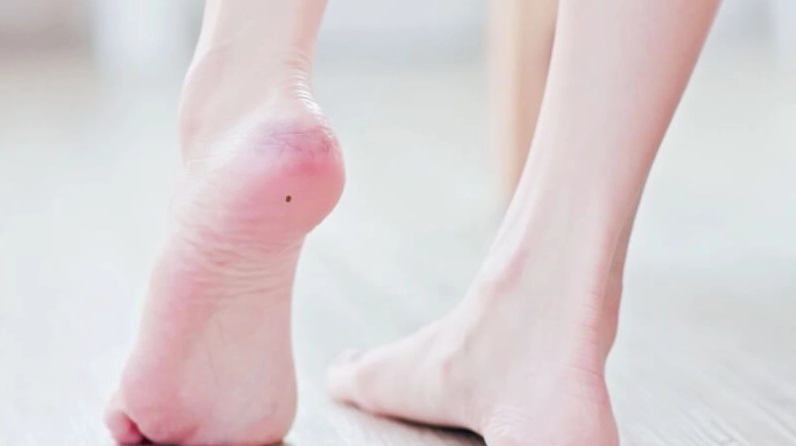 Nốt ruồi ở gót chân trái và phải có sự khác nhau